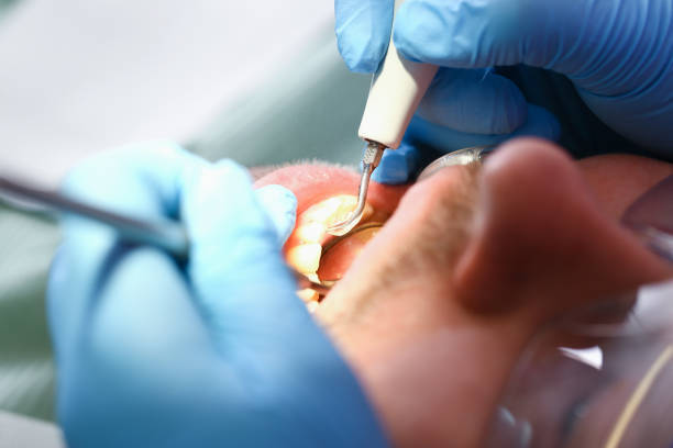Best Emergency Tooth Extraction in Hilton, NY